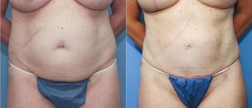 Tummy Tuck Before & After Gallery - Patient 58172407 - Image 1