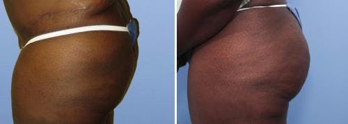 Brazilian Buttock Lift Before & After Gallery - Patient 58172408 - Image 2