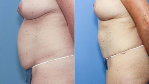 Tummy Tuck Before & After Gallery - Patient 58172407 - Image 2