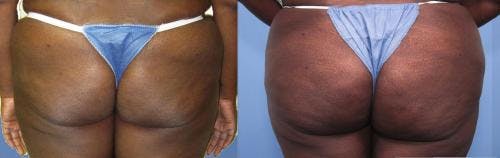Brazilian Buttock Lift Before & After Photos Patient 278