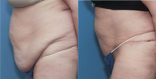 Tummy Tuck Before & After Gallery - Patient 58172409 - Image 2