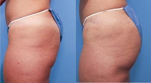 Brazilian Buttock Lift Before & After Gallery - Patient 58172410 - Image 2
