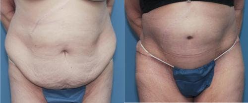 Tummy Tuck Before & After Gallery - Patient 58172409 - Image 1