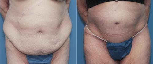 Tummy Tuck