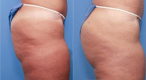 Brazilian Buttock Lift Before & After Gallery - Patient 58172410 - Image 3