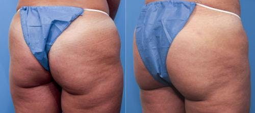 Brazilian Buttock Lift Before & After Gallery - Patient 58172410 - Image 1