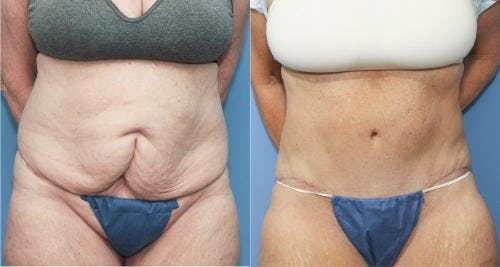 Tummy Tuck Before & After Gallery - Patient 58172411 - Image 1