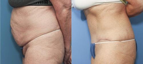 Tummy Tuck Before & After Gallery - Patient 58172411 - Image 2