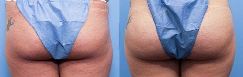 Brazilian Buttock Lift Before & After Gallery - Patient 58172412 - Image 1