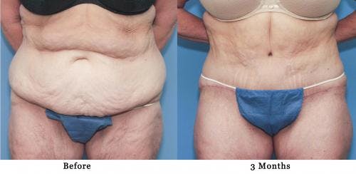 Tummy Tuck Before & After Gallery - Patient 58172413 - Image 1