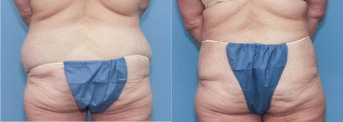 Tummy Tuck Before & After Gallery - Patient 58172413 - Image 2