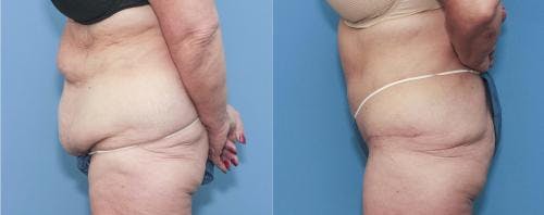 Tummy Tuck Before & After Gallery - Patient 58172413 - Image 3
