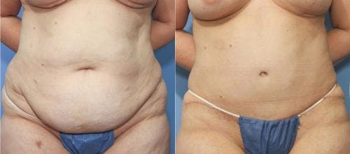 Tummy Tuck Before & After Gallery - Patient 58172414 - Image 1
