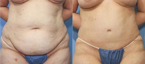 Tummy Tuck