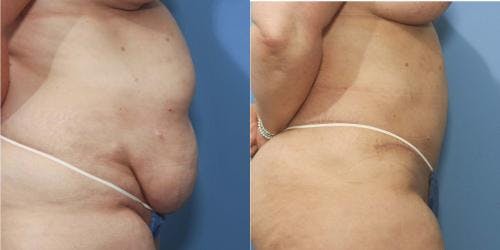 Tummy Tuck Before & After Gallery - Patient 58172414 - Image 2