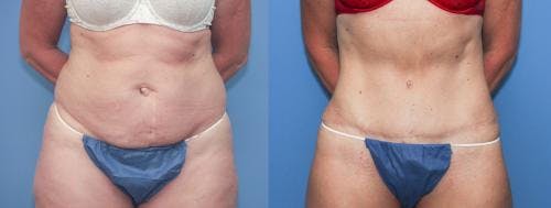 Tummy Tuck Before & After Gallery - Patient 58172415 - Image 1