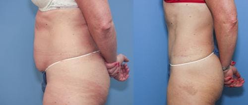 Tummy Tuck Before & After Gallery - Patient 58172415 - Image 2