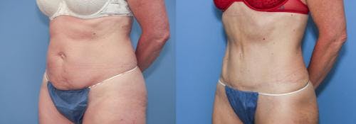 Tummy Tuck Before & After Gallery - Patient 58172415 - Image 3