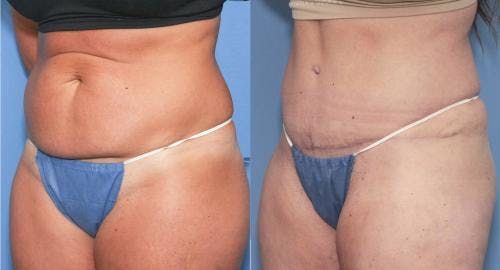 Tummy Tuck Before & After Gallery - Patient 58172416 - Image 2