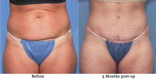 Tummy Tuck Before & After Gallery - Patient 58172416 - Image 1