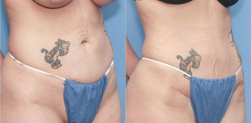 Tummy Tuck Before & After Gallery - Patient 58172417 - Image 1