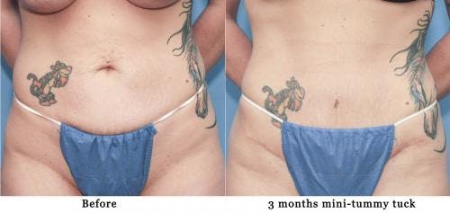 Tummy Tuck Before & After Gallery - Patient 58172417 - Image 2