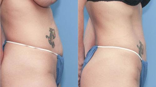 Tummy Tuck Before & After Gallery - Patient 58172417 - Image 3
