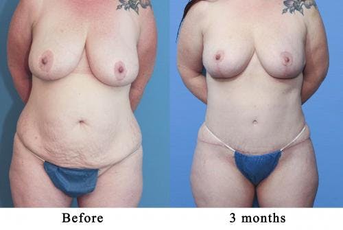 Tummy Tuck Before & After Gallery - Patient 58172418 - Image 1