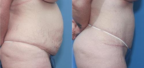 Tummy Tuck Gallery - Patient 58172418 - Image 3