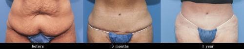 Tummy Tuck Before & After Gallery - Patient 58172419 - Image 2