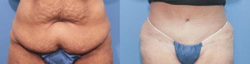 Tummy Tuck Before & After Gallery - Patient 58172419 - Image 1