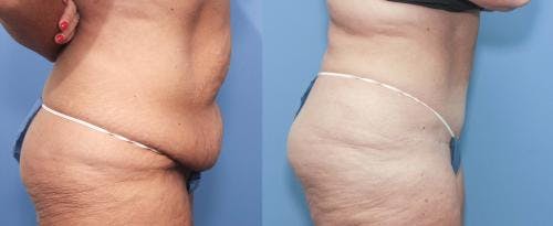 Tummy Tuck Before & After Gallery - Patient 58172419 - Image 3