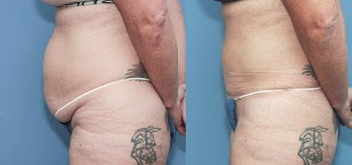 Tummy Tuck Before & After Gallery - Patient 58172421 - Image 1