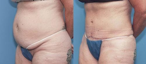 Tummy Tuck Before & After Gallery - Patient 58172421 - Image 2