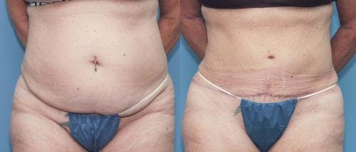 Tummy Tuck Before & After Gallery - Patient 58172421 - Image 3