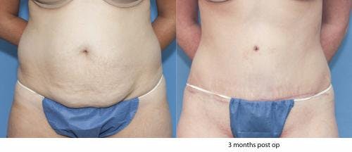 Tummy Tuck Before & After Gallery - Patient 58172422 - Image 1