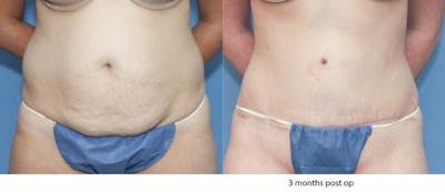 Tummy Tuck Before & After Gallery - Patient 58172422 - Image 1