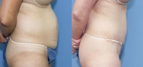 Tummy Tuck Before & After Gallery - Patient 58172422 - Image 2