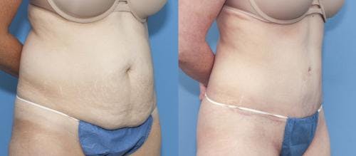 Tummy Tuck Before & After Gallery - Patient 58172422 - Image 3