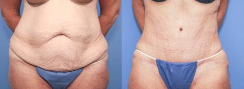 Tummy Tuck Before & After Gallery - Patient 58172423 - Image 1