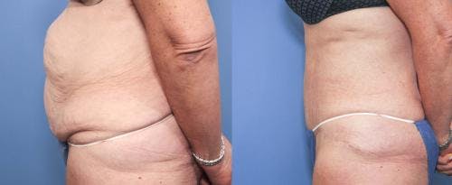 Tummy Tuck Before & After Gallery - Patient 58172423 - Image 2