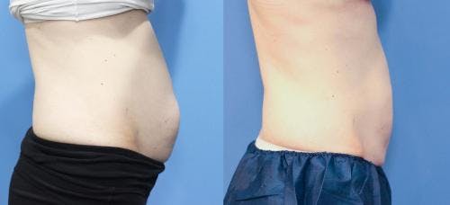 CoolSculpting