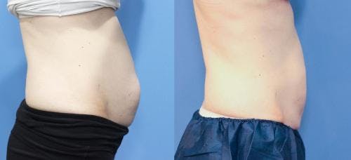 Body Before & After Gallery - Patient 58173347 - Image 1