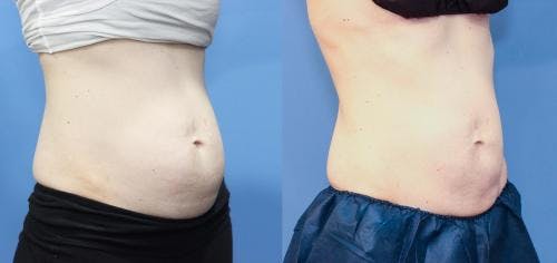 Body Before & After Gallery - Patient 58173347 - Image 3