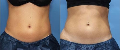 Body Before & After Gallery - Patient 58178475 - Image 1