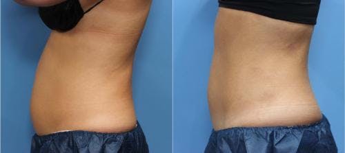 Body Before & After Gallery - Patient 58178475 - Image 2
