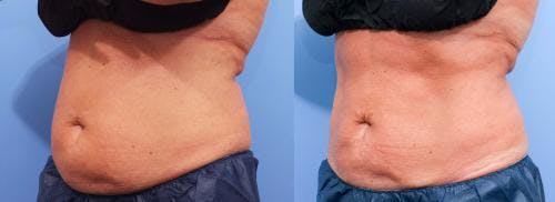 Body Before & After Gallery - Patient 58178476 - Image 1