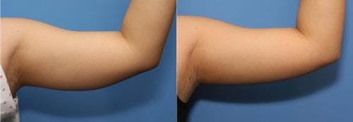 Arms Before & After Gallery - Patient 58178477 - Image 1