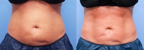 Body Before & After Gallery - Patient 58178476 - Image 3