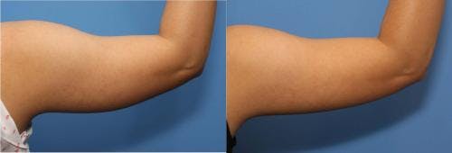 Arms Before & After Gallery - Patient 58178477 - Image 2